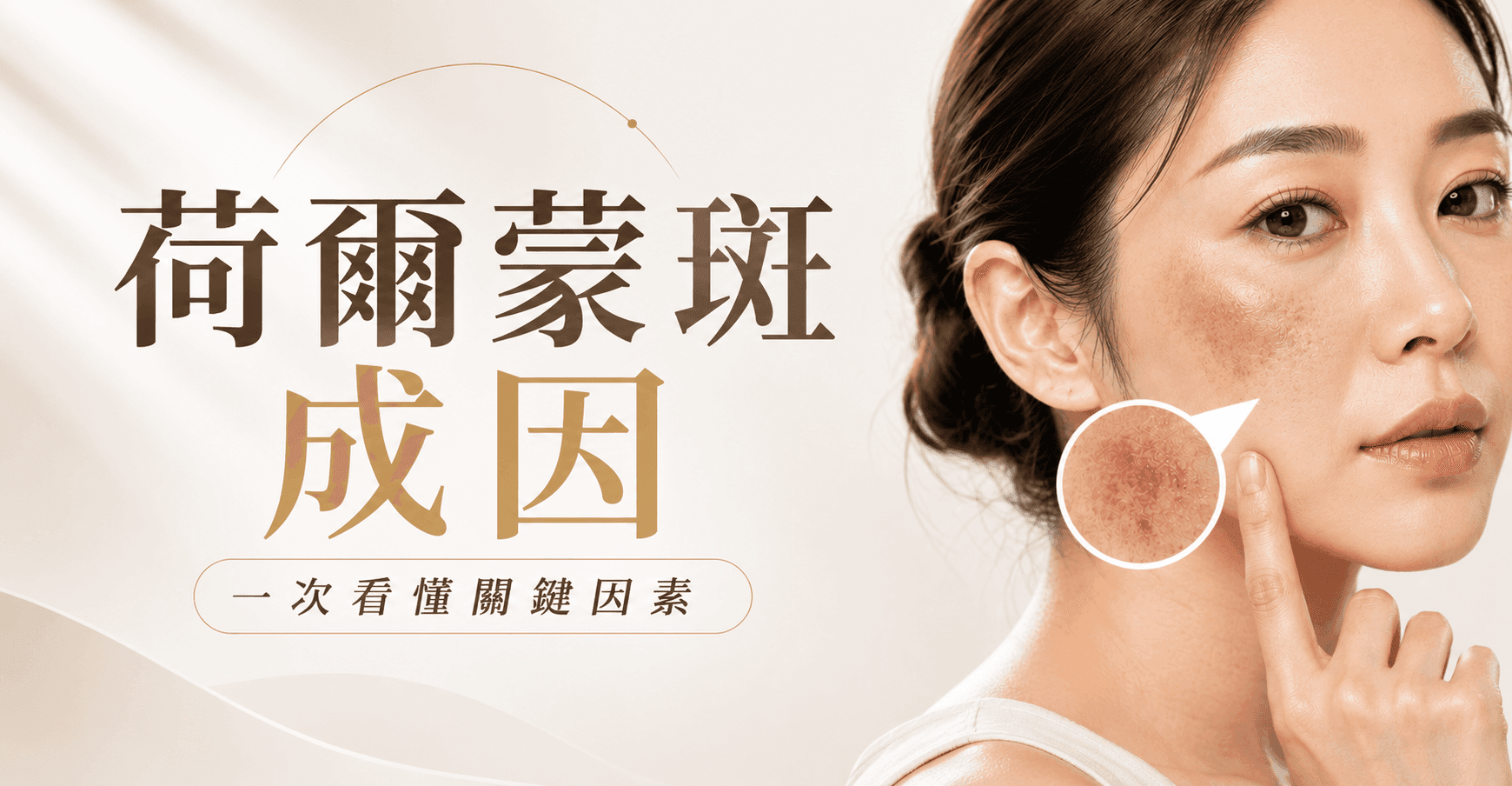 荷爾蒙斑成因